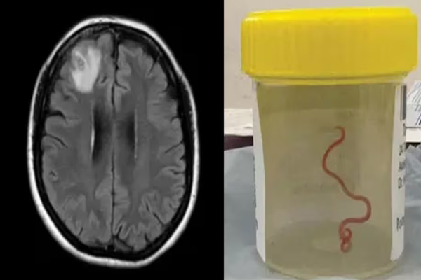 OMG: Worm found alive in womans brain, worlds first case mastram